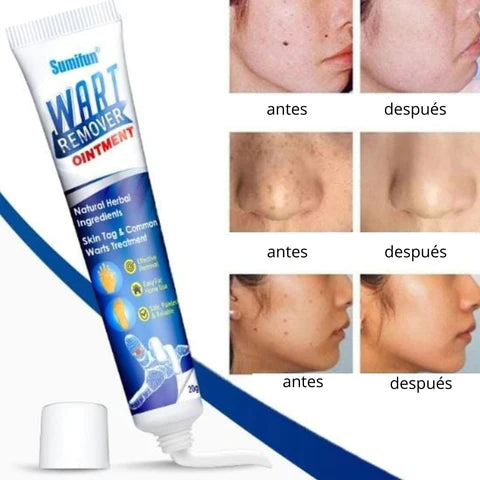Wart Remover - Renovedor de verrugas D T